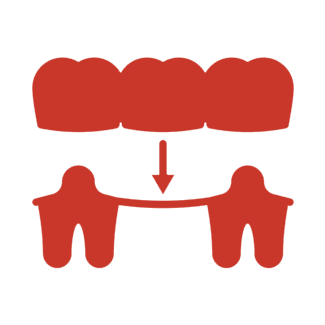 Dental Bridges